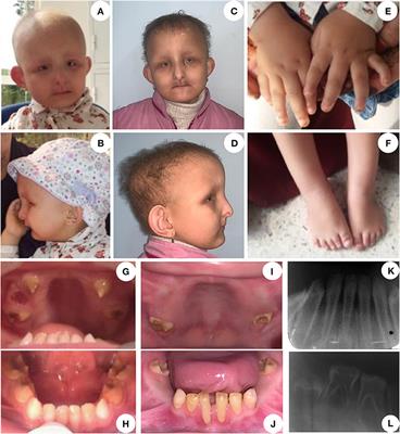 A Novel Homozygous Variant in GJA1 Causing a Hallermann-Streiff/Oculodentodigital Dysplasia Overlapping Phenotype: A Clinical Report